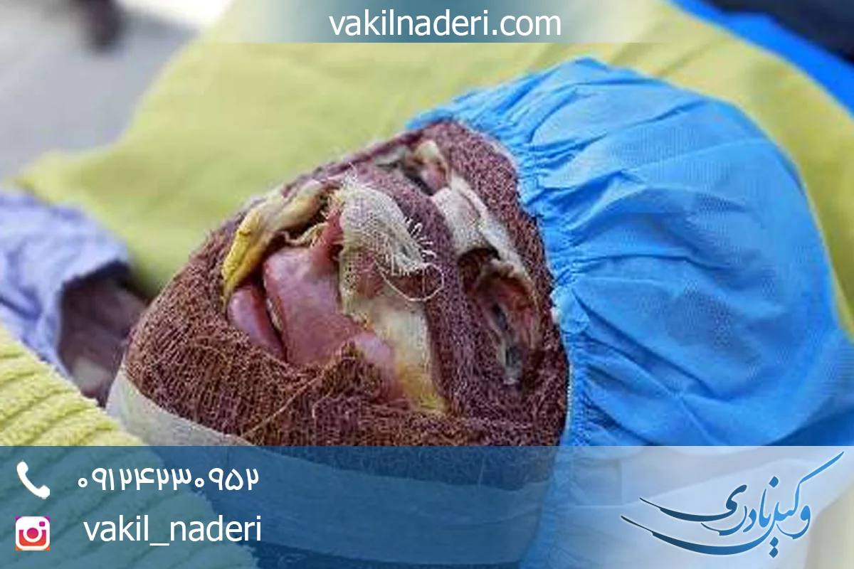 وکیل اسید پاشی